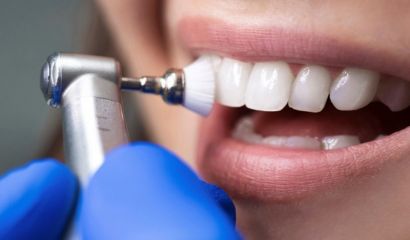 Teeth Cleaning Tirupati